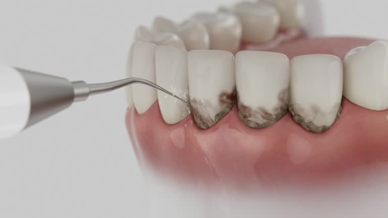 Reliable Wisdom Tooth Removal contractor in Benbrook, TX by Smile Center Dentistry